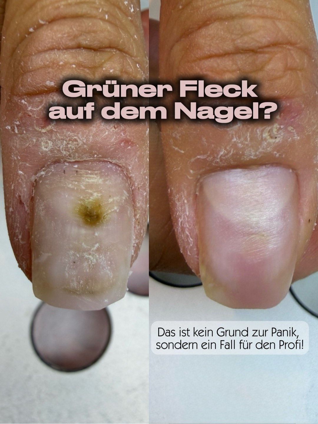 Die Wahrheit über grüne Flecken auf dem Nagel (Green Nail Syndrome) 🟢
Was viele im ersten Moment für einen aggressiven Nagelpilz halten, ist in der Realität meist eine bakterielle Infektion, verursacht durch den Erreger Pseudomonas. Dieser nistet sich besonders gerne dort ein, wo Feuchtigkeit und Sauerstoffmangel aufeinandertreffen – zum Beispiel unter unbemerkt gelösten Stellen (Liftings) einer Kunstnagelmodellage.
In den Bild dokumentieren wir einen klassischen Verlauf aus unserem Studio: Links der Befund bei der Erstvorstellung, rechts das Ergebnis nach genau 6 Wochen.
Wie sind wir vorgegangen?
Eine professionelle Sanierung erfordert mehr als nur optische Kosmetik. Das Überfeilen oder einfache Überlackieren verschlimmert das Problem massiv. Unsere Strategie im Studio basierte auf drei Säulen:
1️⃣ Keimreduktion & Reinigung: Fachgerechtes Abtragen der betroffenen Schichten und Desinfektion des Areals.
2️⃣ Spezifische Studio-Wirkstoffe: Einsatz von Produkten, die das Milieu für das Bakterium unbewohnbar machen.
3️⃣ Wachstumsförderung: Unterstützung der Nagelplatte bei der Regeneration, damit die Verfärbung restlos und gesund herauswächst.
Das Ergebnis: Nach nur anderthalb Monaten ist der Nagel vollständig regeneriert, bakterienfrei und wächst perfekt gesund nach.
Unser Rat als Experten:
Solltest du unter deiner Modellage eine grünliche oder bräunliche Verfärbung entdecken, handle schnell. Je früher wir den Nagel mit den passenden Spezialprodukten behandeln, desto schneller und unkomplizierter ist der Regenerationsprozess.
Anomalien an den Nägeln? Wir analysieren die Ursache und helfen dir gezielt.
📥 Sende uns eine Nachricht für eine professionelle Beratung oder vereinbare direkt deinen Termin.